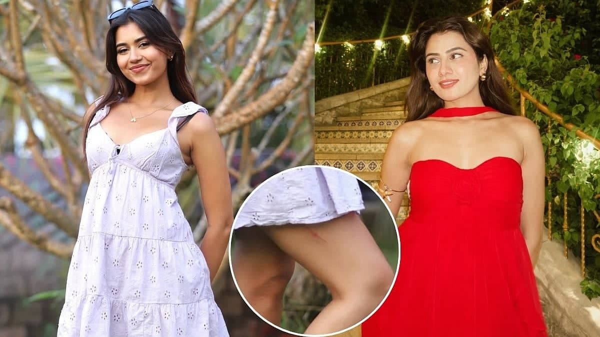 Akanksha Ka Scar: Splitsvilla Ki Drama Ki Kahani Chali