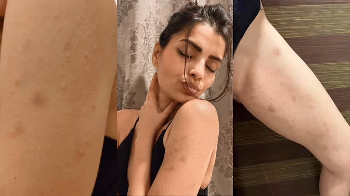 Sonali Raut Ki Skin Infection Ki Kahani: Bigg Boss Ka Raaz